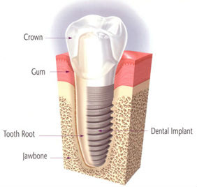 Dental Implants | Colton Family Dental | Devang J. Patel, D.D.S. | Colton, CA 92324