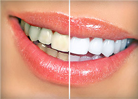 Teeth Whitening | Colton Family Dental | Devang J. Patel, D.D.S. | Colton, CA 92324